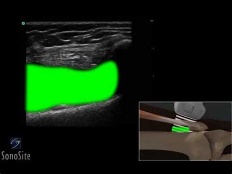 3D How to: Ultrasound Guided Injection of the Lateral Knee - SonoSite ...