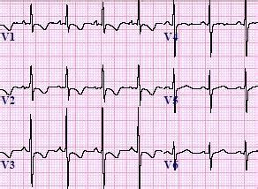 Right Ventricular Hypertrophy (RVH) ECG Review | Learn the Heart