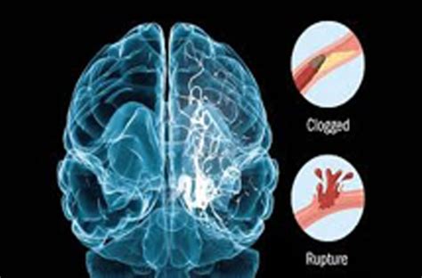 Hemiplegia (Stroke)