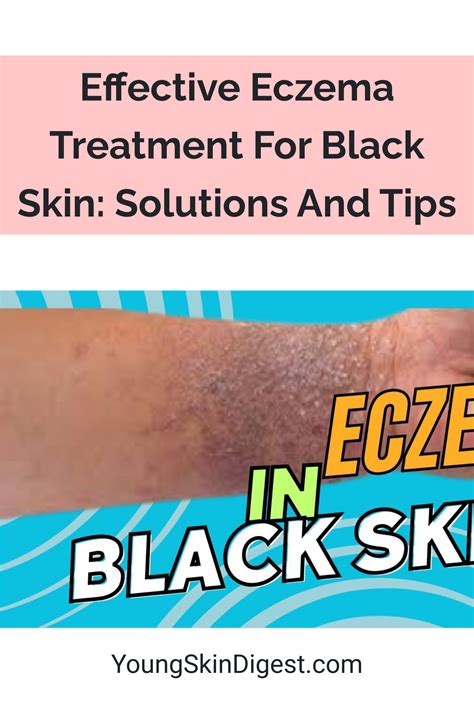 Effective Eczema Treatment For Black Skin: Solutions And Tips - Young ...