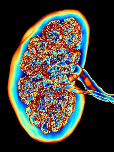 Ct Scan Of Kidney