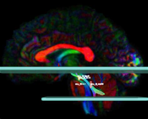 Superior Cerebellar Peduncle (scp) | Whole Brain Protocol for ...