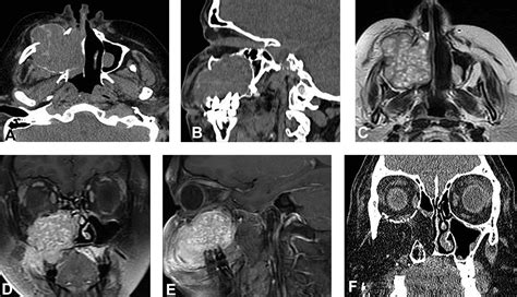 Central Giant Cell Granuloma Radiology Case, 53% OFF