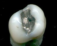 Dental restoration - wikidoc