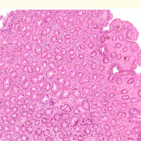 Increased intraepithelial lymphocytes only. | Download Scientific Diagram