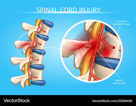 Human spinal cord injury anatomical scheme Vector Image