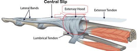 The ArmDoc - Traumatic Extensor Hood Rupture