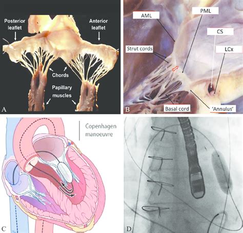 —subvalvular apparatus. a) anatomical specimen of human mitral valve... | Download Scientific ...