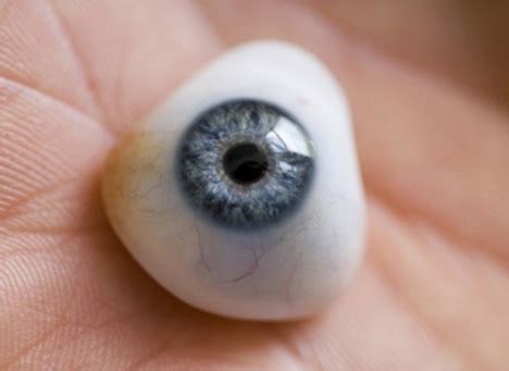 Ocularist and Artificial Eyes in India: Artificial Eye