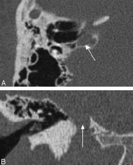 A , Coronal CT image shows a bony defect along the tegmen tympani with... | Download Scientific ...