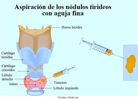 Nódulos tiroideos, síntomas, benignos, malignos, tamaño, causas y tratamiento