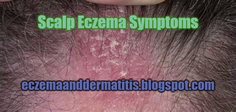 Scalp Eczema Symptoms - Eczema and Dermatitis