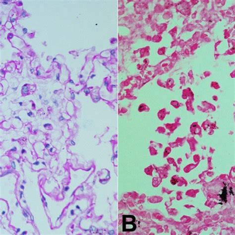 Photomicrographs of the lung showing in A -PAS stain, and B -von Kossa... | Download Scientific ...