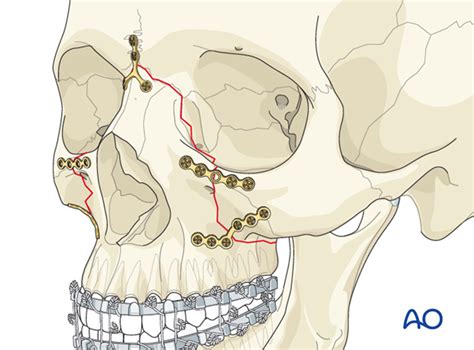 Maxillary Fracture Classification