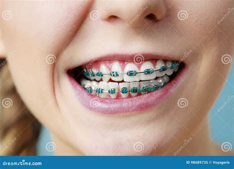 Funny Expression With Braces Stock Photo | CartoonDealer.com #25153824