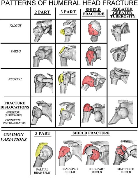 Figure 1 from Natural history of complex fractures of the proximal ...