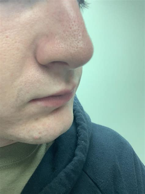 HELP large pores oily nose : r/Rosacea