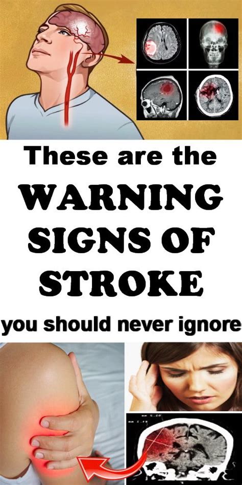 These are the warning signs of a stroke you should never ignore. #stroke #bleeding | Tongue ...