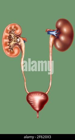 Renal calculi, kidney stone, urinary system of a woman with kidney, adrenal gland, artery, veins ...