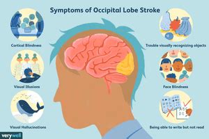 Stroke Symptoms