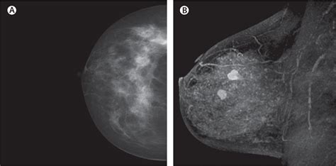 MRI for breast cancer screening, diagnosis, and treatment - The Lancet