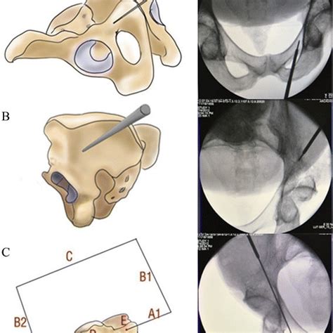 a shows the cross-section of the acetabular notch, which presents the... | Download Scientific ...