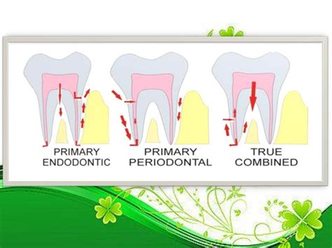 Endo perio lesions