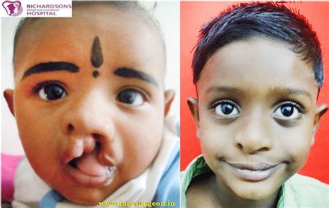 child cleft palate surgery hospital in India - Richardsons Hospital