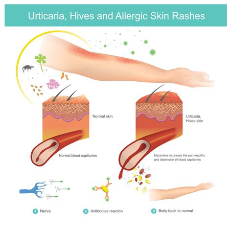 Urticaria Face Rash