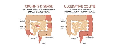 crohn s disease vs ulcerative colitis chart - Keski