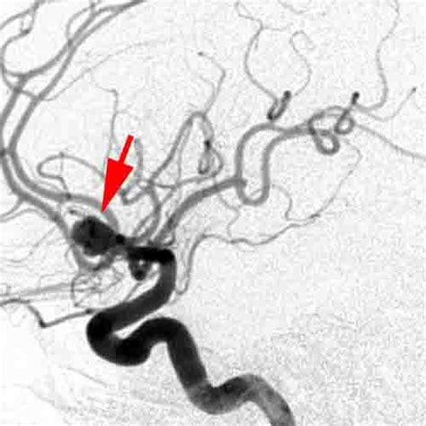 Cerebral angiogram shows the aneurysm (arrows) that was responsible for the bleed.