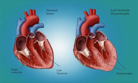 Left ventricular hypertrophy (LVH), also known as an enlarged heart, is ...