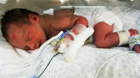 NICU equipment - Neonatal intensive care unit