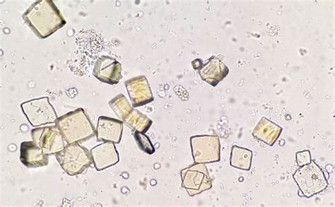 Uric Acid Crystals In Urine