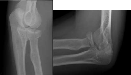 Radial head / neck fractures of the elbow | CUH