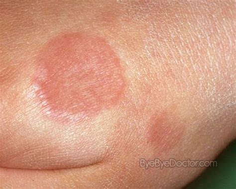 Granuloma Annulare – Treatment, Symptoms, Causes, Pictures, Cure - Minhhai2d Help Doctor