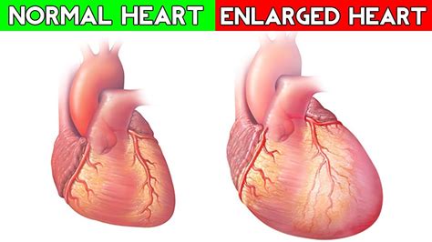 Enlarged Heart - Causes, Signs, Symptoms, Treatment