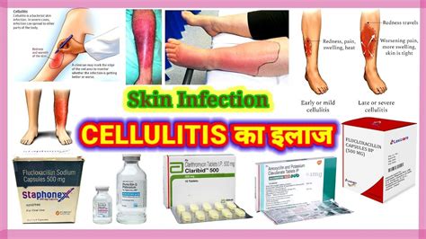 Cellulitis Treatment