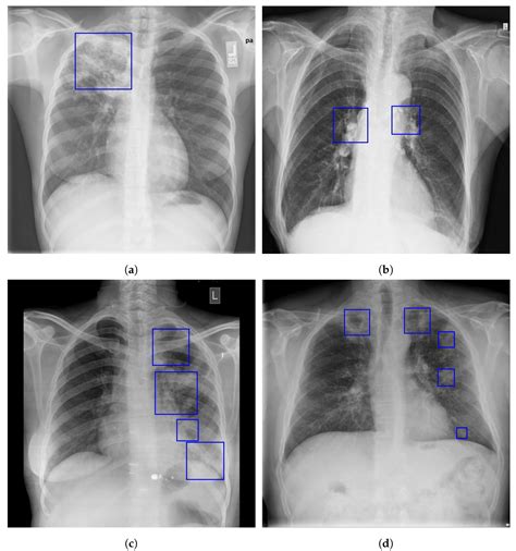 Tuberculosis Vs Pneumonia X Ray