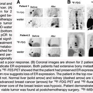 (PDF) The Role of Radiotracer Imaging in the Diagnosis and Management of Patients with Breast ...