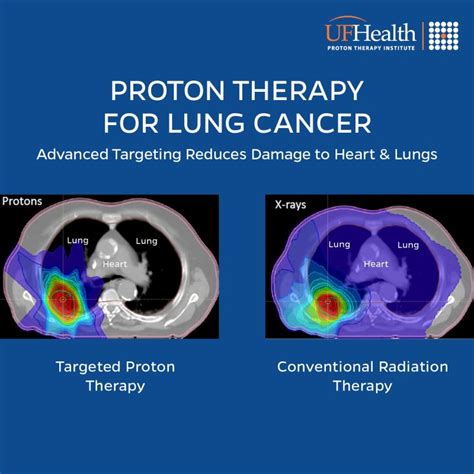 UF Health Proton Therapy Institute on LinkedIn: Proton Therapy for Lung Cancer Treatment