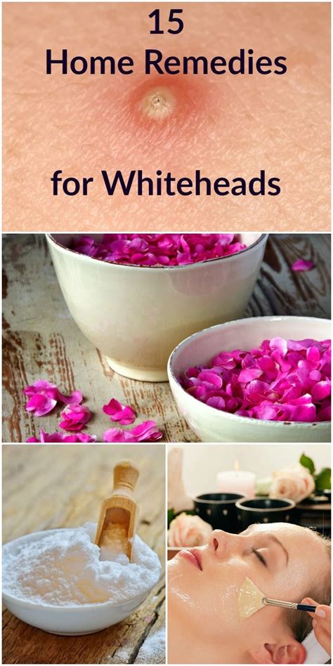 15 Home Remedies for Whiteheads - Selfcarer | Whiteheads, Whiteheads remedy, Home remedies