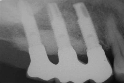 5: Decision Making in Bone Augmentation to Optimize Dental Implant ...