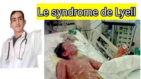 Le syndrome de Lyell ou nécrolyse épidermique toxique (NET) - YouTube