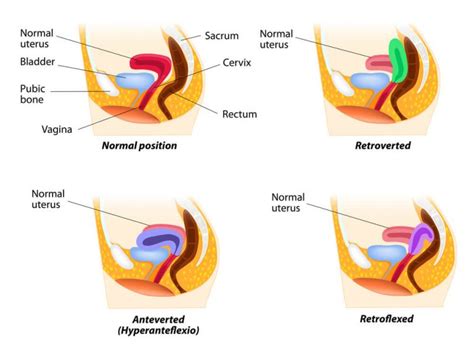 A Useful Guide to Retroverted Uterus