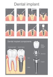 Osteoporosis And Dental Implants - Houston, TX