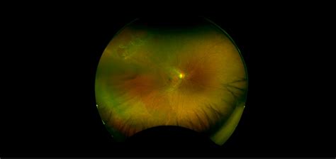 Retinal Tear Ultrasound