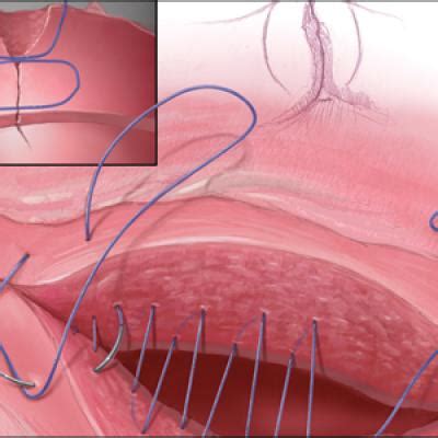 Uterine incision closure: Is it the culprit in the cesarean scar niche and related complications ...