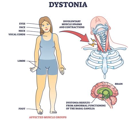 Cervical dystonia and spasmodic torticollis treatment