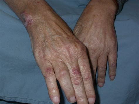 SWEET SYNDROME – Dermatology Conditions and Treatments